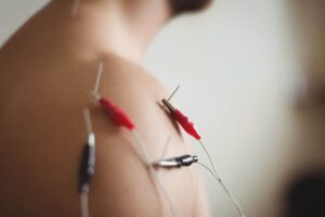 How Peripheral Nerve Stimulation (PNS) Can Help Relieve Chronic Pain